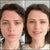<p>Cleared Blemishes & Redness</p>
